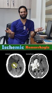 CT Brain Stroke Basics — Ischemic vs Hemorrhagic Made Simple! Spot the difference in seconds with clear CT signs, bleed patterns, and vascular territory involvement. Perfect for students, radiographers, and anyone learning neuro-imaging! In this reel, I have explained how to differentiate ischemic and hemorrhagic strokes on CT scan using quick, practical points. Covered topics include: 🔹 Ischemic Stroke Signs • Loss of gray–white differentiation • Sulcal effacement • Hypodensity • Dense MCA sig