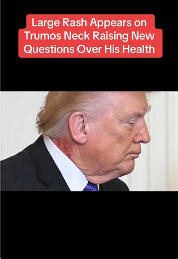 Large Rash Appears on Trumos Neck Raising New Questions Over His Health 3/2