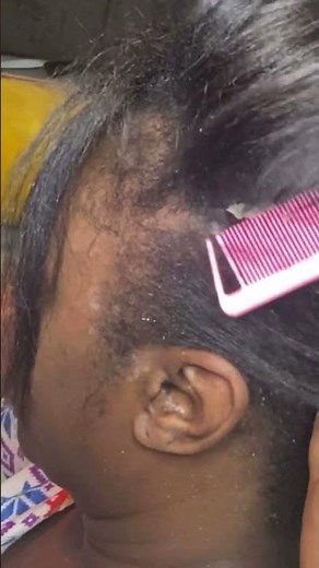 Scratching a huge patch of dandruff. #dandruffscratching #dandruff #scalp #dandruffremoval