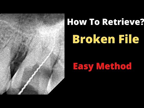 How to Retrieve Broken File from The Canal?| Management of separated file| File Bypass| Easy Method