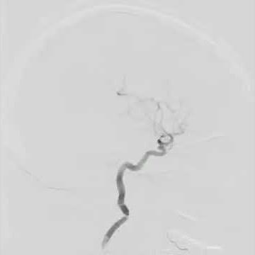 Brain angiogram aneurysm