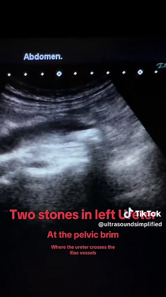 Understanding Ureteric Stones and Hydronephrosis
