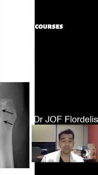 Top Causes of AVN (Avascular Necrosis): Steroids, Trauma, Alcohol & the Hidden Risks