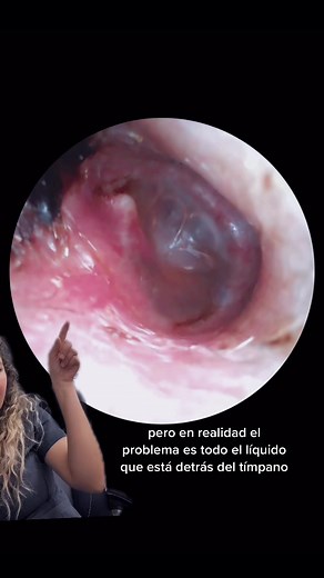 Sientes el oido tapado? Puedes gener esto…. #otorrinolaringologia #otorrino #otitis #moco #liquido #infeccion