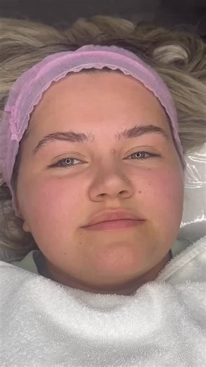 Million Dollar Facial is a luxury 10 step facial combining Dermaplaning, lymphatic drainage and microneedling. Just look at how much life is put into my clients skin ✨ | By Kirstie Marie