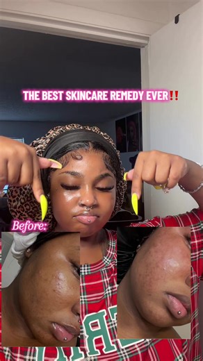 Effective Acne Treatment with Dr. Leo's Drying Lotion