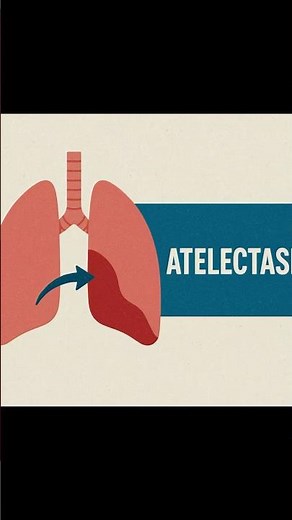 “Atelectasis Explained: Causes, Symptoms & Nursing Care” #nursingofficer #nursing #bfuhs #pgiexam