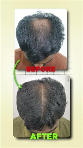 GFC Results Hair Fall to Hair Growth 😱