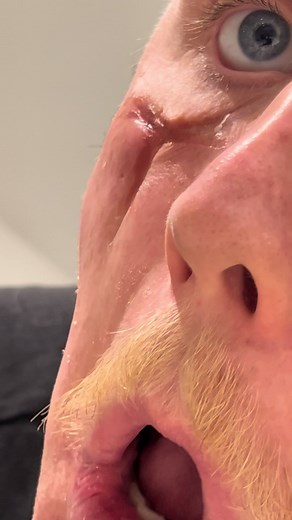 Special Effects Makeup Tutorial: Creating Scars like the Joker