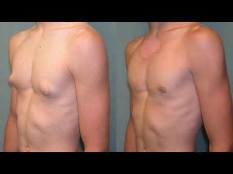 HOW TO GET RID OF GYNECOMASTIA SIMPLE STEPS