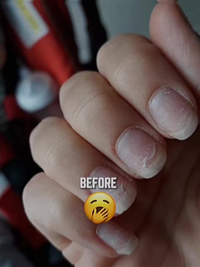 toenail fungus treatment, home remedies for nail fungus, yellow toenails cure, how to get rid of foot fungus, podiatrist tips fungus, tea tree oil for fungus, Vicks for toenail fungus, thick toenail treatment, athletic foot care, antifungal remedies, fungus infection, foot health guide.