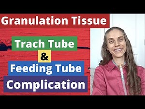 Granulation Tissue: Trach Tube, Feeding Tube, & Indwelling Catheter Complication. Life with a Vent