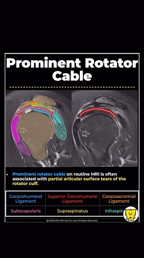 MSKMRI | 📌 Rotator Cable Overview The rotator cable is a thick, fibrous structure in the shoulder, resembling a suspension bridge. It transfers... | Instagram