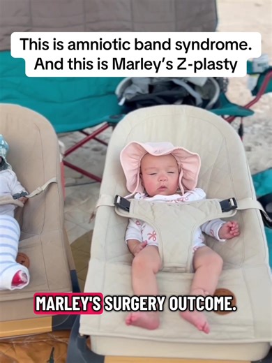 Our little Amniotic Band Syndrome Frankenstein baby 💚 #amnioticbandsyndrome #limbdifference #twins #medicalmom #foryoupage