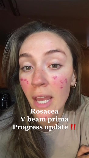 VBeam Prima Laser Treatment for Rosacea Progress Update