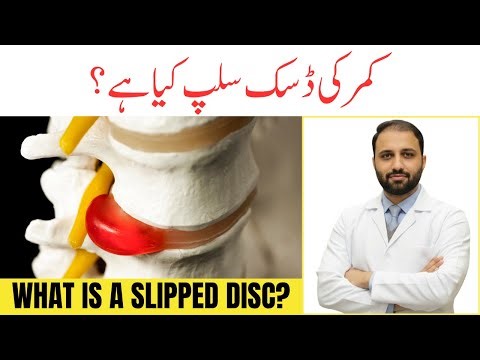 What is Lumbar Disc Herniation | Causes, Symptoms & Patient Education | Slipped Disc Explained