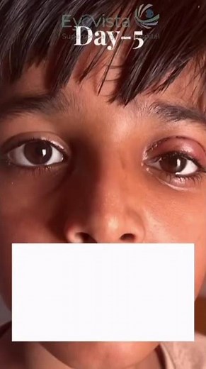 Ptosis (Drooping Eyelid) in Children: Causes & Treatment | Dr. Ankit Shah