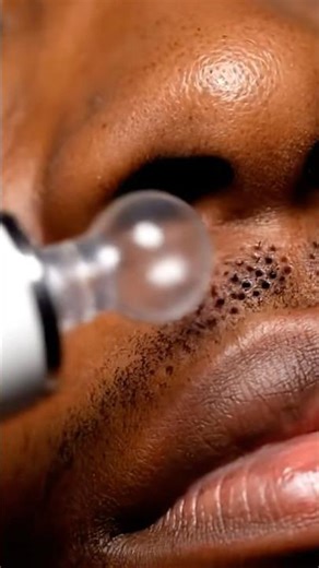 Extreme Pore Vacuum Extraction! 😱 Gone in Seconds #skincare #shorts #viral