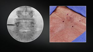 Medial Branch Nerve Transection Procedure