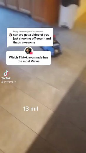 Exploring Polydactyly: My Unique Six-Fingered Hand Revealed