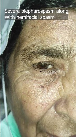 Blepharospasm along with hemifacial spasm