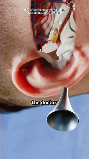 Ear Tube Placement (Tympanostomy Tubes) 3D Animation