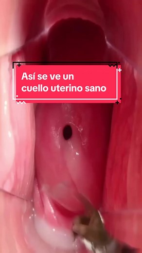 Cuello Uterino Sano: Importancia del Papanicolau y Colposcopia