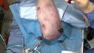 Bankart Repair for Anterior Shoulder Instability