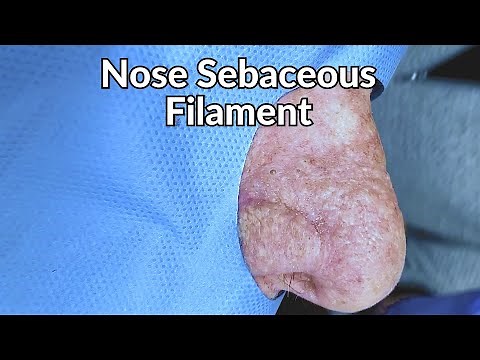 Removing LOTS of Nose Cheese! (Sebaceous Filament Extraction) | CONTOUR DERMATOLOGY