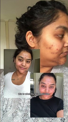 she cleared her hormonal acne with this 3-step lelive routine