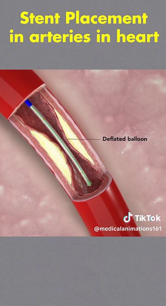 Stent Placement Procedure Explained | Heart | 3D Animation