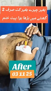 #doctertahiriqbal2025 #babarbaiggujrati #fatbellyremoved #loosebellyfatsin3hours #unbelieveablefatbellyremovalsurgery #doctertahiriqbal #babarbaiggujrati #fatbellyremoved #loosebellyfatsin3hours #unbelieveablefatbellyremovalsurgery #abhdtv #latestvideo2024 #fatbelly #slimbellyin3hours #loosefatbelly #Surgery #fatbellyremoved #loosebellyfatsin3hours #abhdtv #drzahidiqbalbhtti #subhanhospitalkharian @AB HD TV #doctertahiriqbal #babarbaiggujrati #unbelieveablefatbellyremovalsurgeryq #Babarbaiggujra
