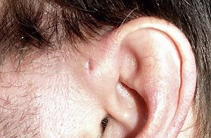 11 Meanings of Preauricular Sinus in the Bible: Hole in The Ear