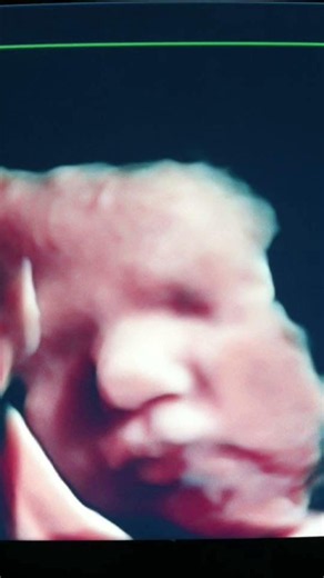 My own experience before I was your ultrasound tech at Hello My Baby 3D. I get you mom! ♥️