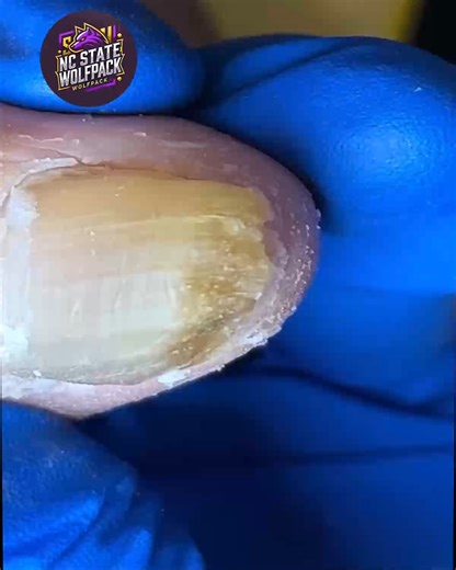 6K views · 41 reactions | Convenient Foot and Nail Tips Backed by US Insurance #FootSupport #HealthyHabits #SimpleHealthTricks | NC State Wolfpack on TheWolfpacker.com | Facebook