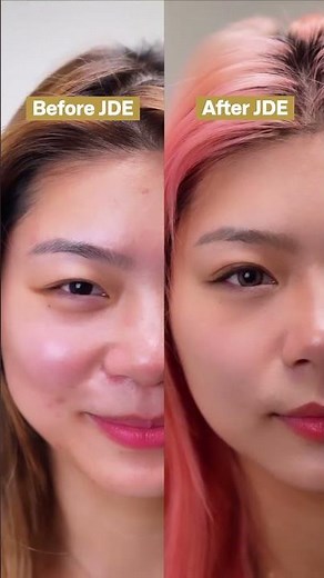 Before and After Double Eyelid Procedure