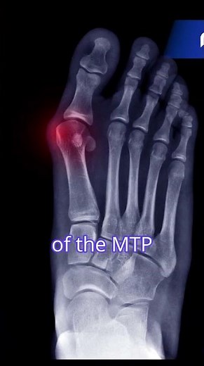 Hallux Valgus: Understanding the Anatomy Behind the Bunion