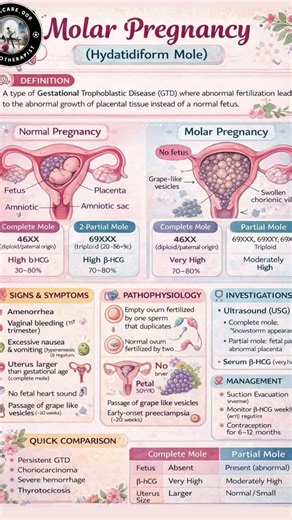Molar Pregnancy (Hydatidiform Mole): Causes, Symptoms & Management