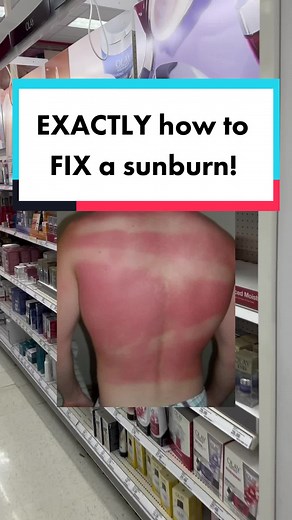 Sunburn Relief and Healing Tips