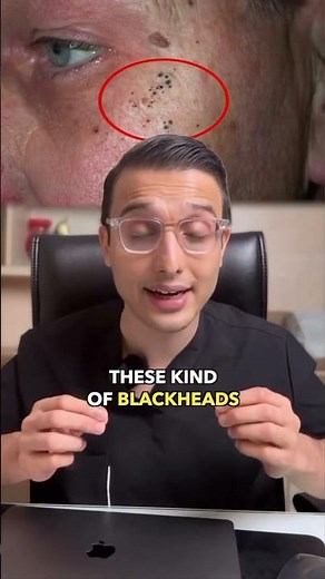 Senile Comedones : Not Your Regular Blackheads. || Dr.Sarin ||