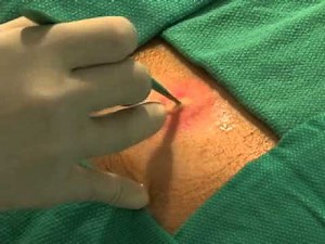 NEJM Abscess Incision and Drainage