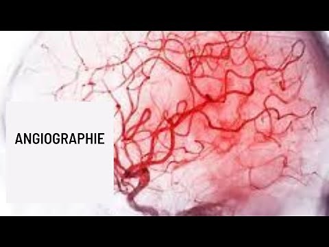 Angiographie