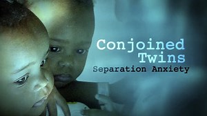 Conjoined Twins: Separation Anxiety (2012)