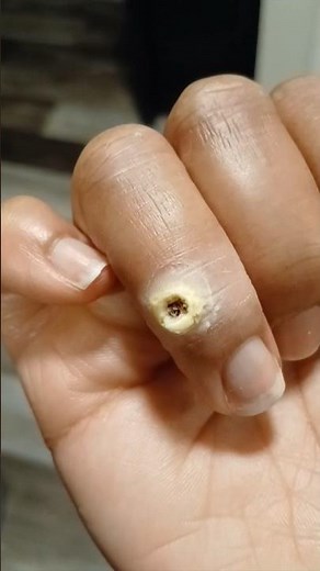 The DIY Wart Removal That Actually Works