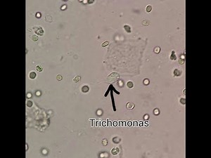 vaginal smear - Trichomonas test in lab - Vaginal swab - Trichomoniasis under micriscop