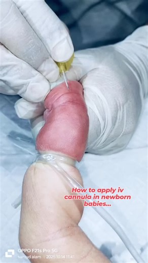 @nicu_nursing_work on Instagram: "Newborn baby cannulation process...👍🏻🏥💉 This video is just love of my profession and for the knowledge and entertainment of the people. #doctor #medicine #medical #health #hospital #nurse #healthcare #doctors #surgery #medicalstudent #medico #neet #surgeon #mbbs #medstudent #covid #dentist #medschool #medicalschool #medicina #love #wellness #physician #futuredoctor #anatomy #nursing #science #dental #healthylifestyle #medlife"