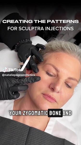 Sculptra Injection Techniques for Natural Results