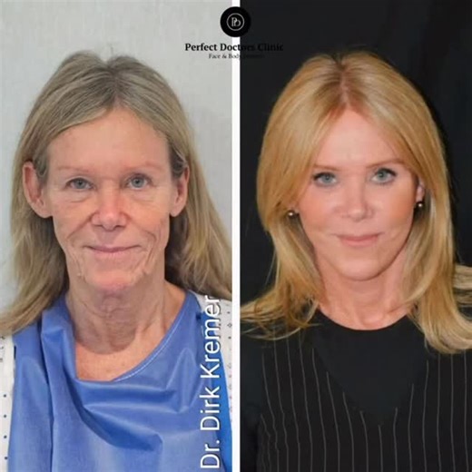 Facial Surgeons ™ on Instagram: "Dr. Kremer (@drdirkkremer) is thrilled to see his 68-year-old patient looking so youthful and radiant. Her case was more complex than usual. She first came to him after years of trying to manage aging with fillers alone, which left her face uneven, asymmetrical, and lumpy. Dr. Kremer explained that at her stage of aging, loose and wrinkled skin can’t be corrected with fillers, and that a true facial rejuvenation would give her the natural results she wanted. She 
