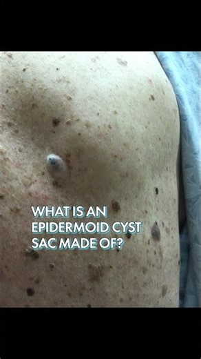 What is the cyst sac made of? #drpimplepopper #popaholics