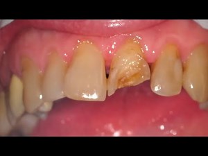 Fixing a Chipped Front Tooth - Dentist POV